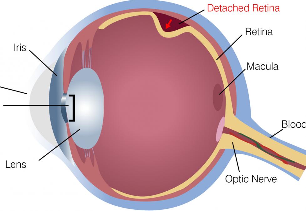 Diagram depicting detached retina