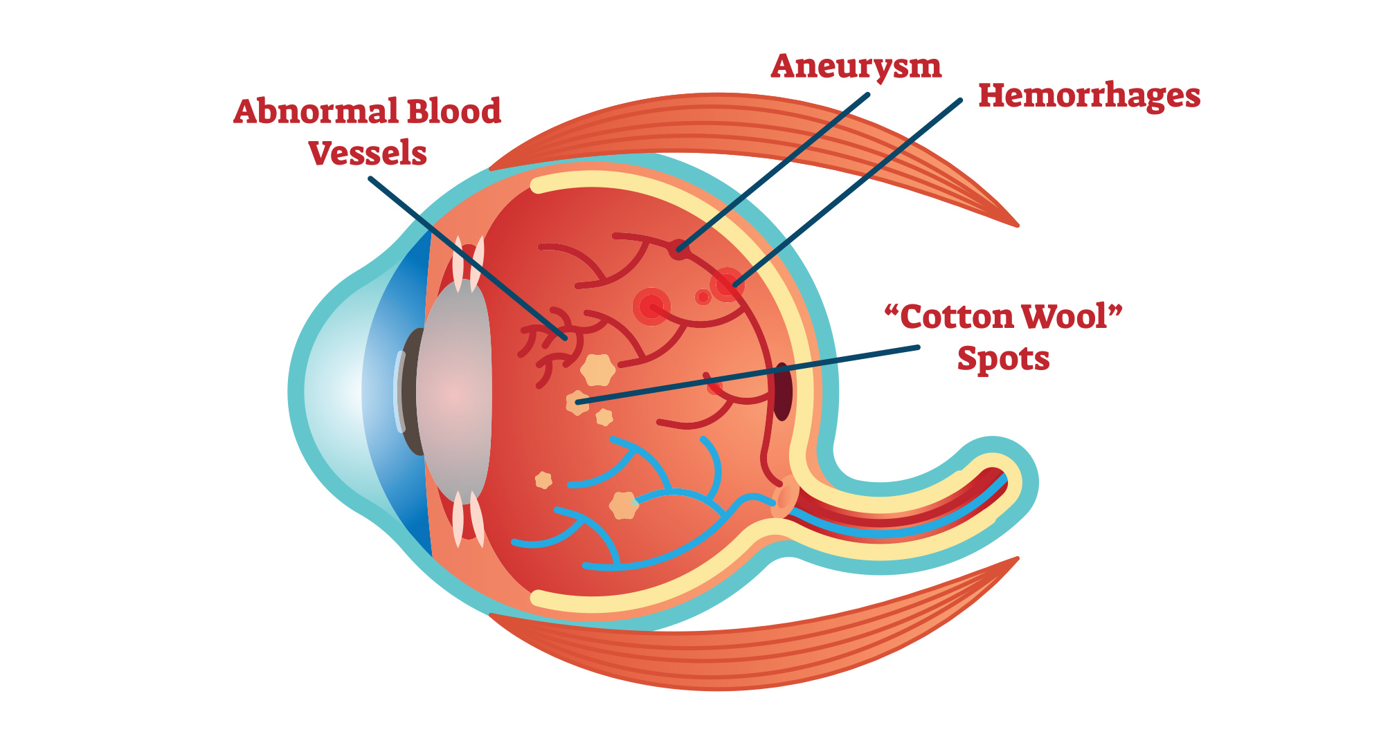 Illustration of eye affected by diabetes