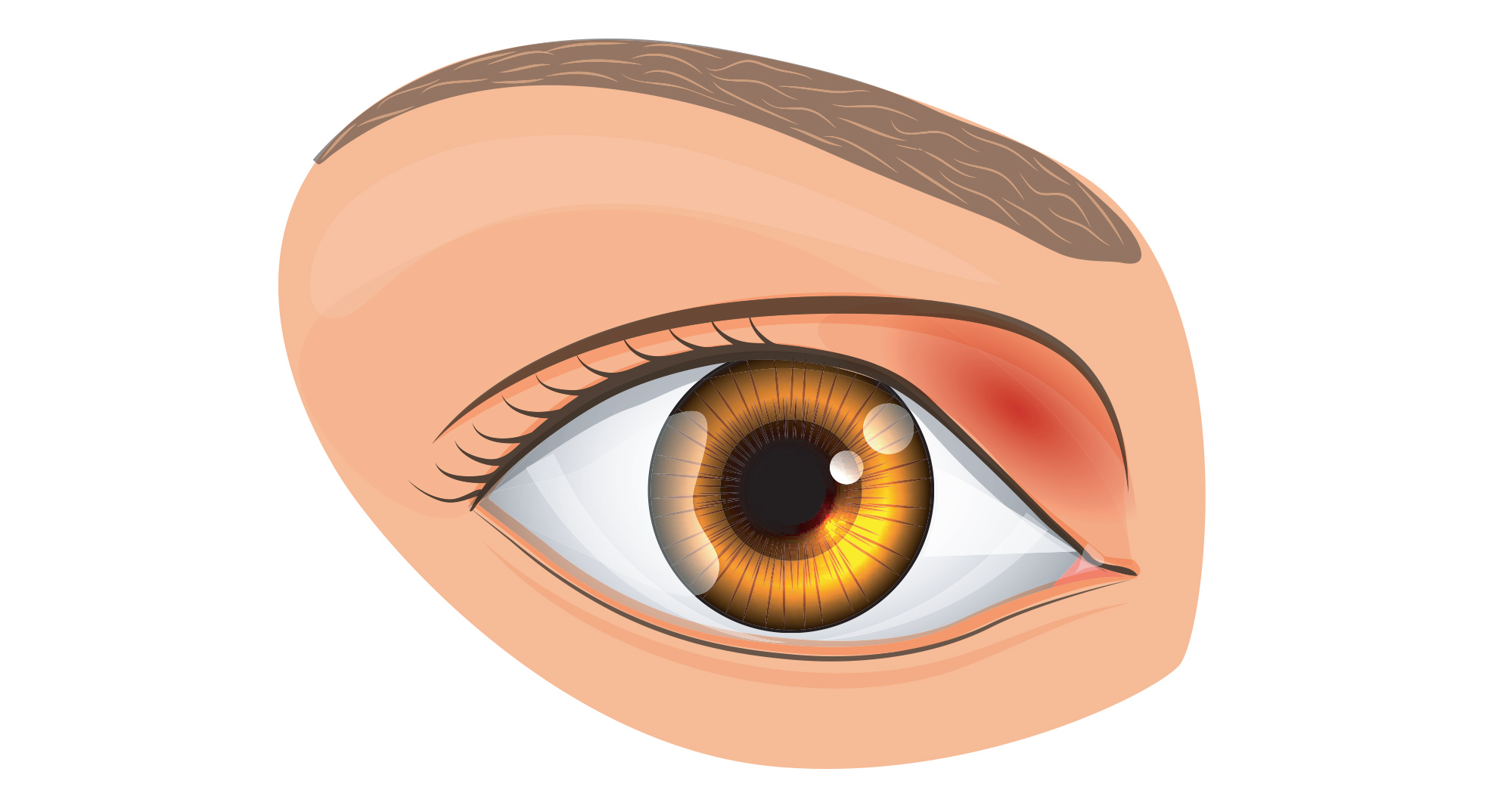 Illustration of eye with stye